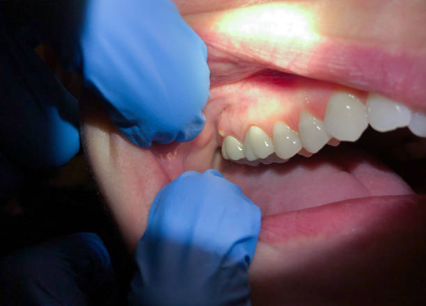 Best Emergency Denture Repair in Weatherly, PA